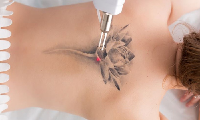 natural tattoo removal